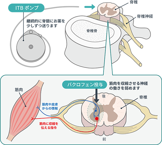 バクロフェン髄腔内投与療法（ITB）のメカニズム